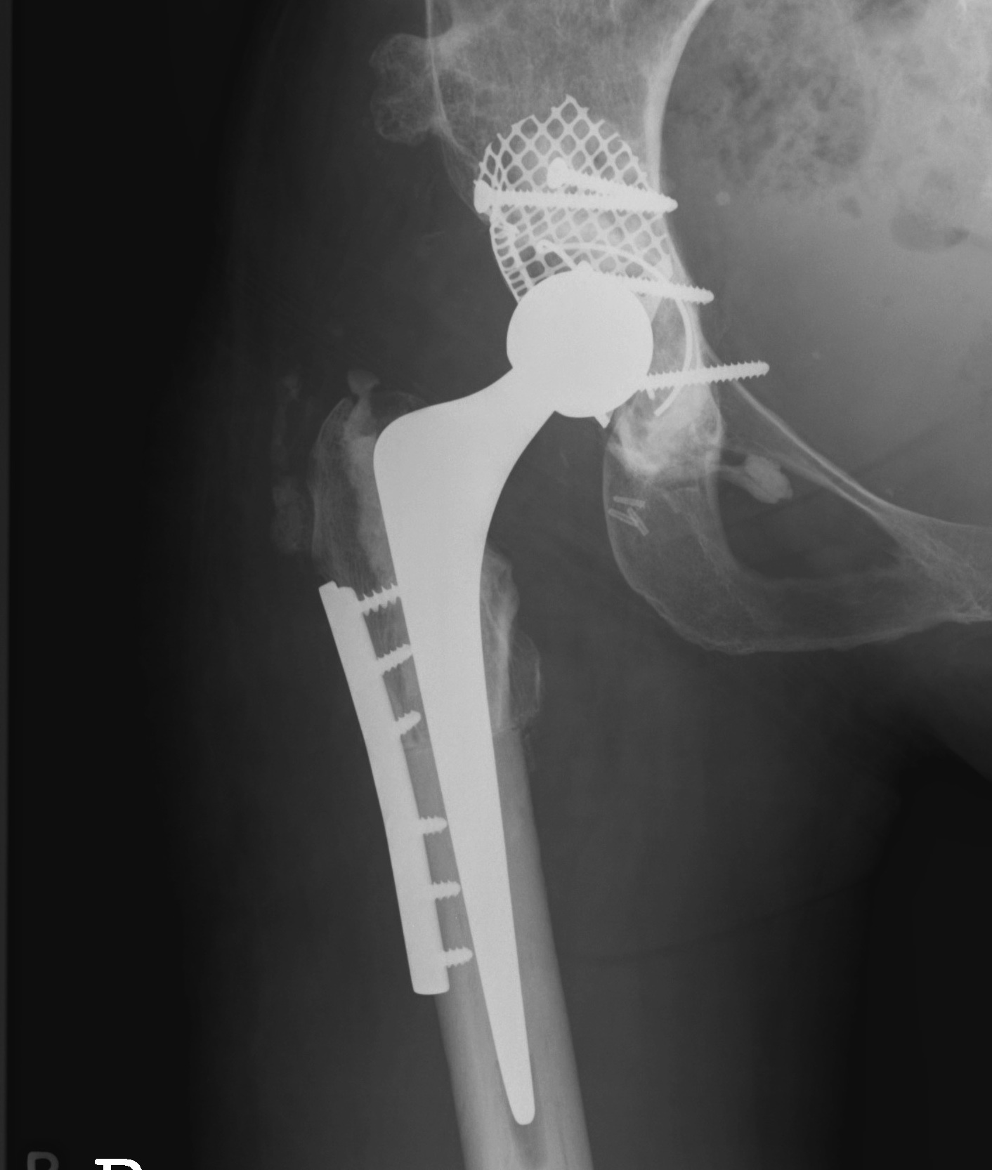 THR Dysplasia Subtrochanteric Osteotomy + Mesh Impaction Bone Graft